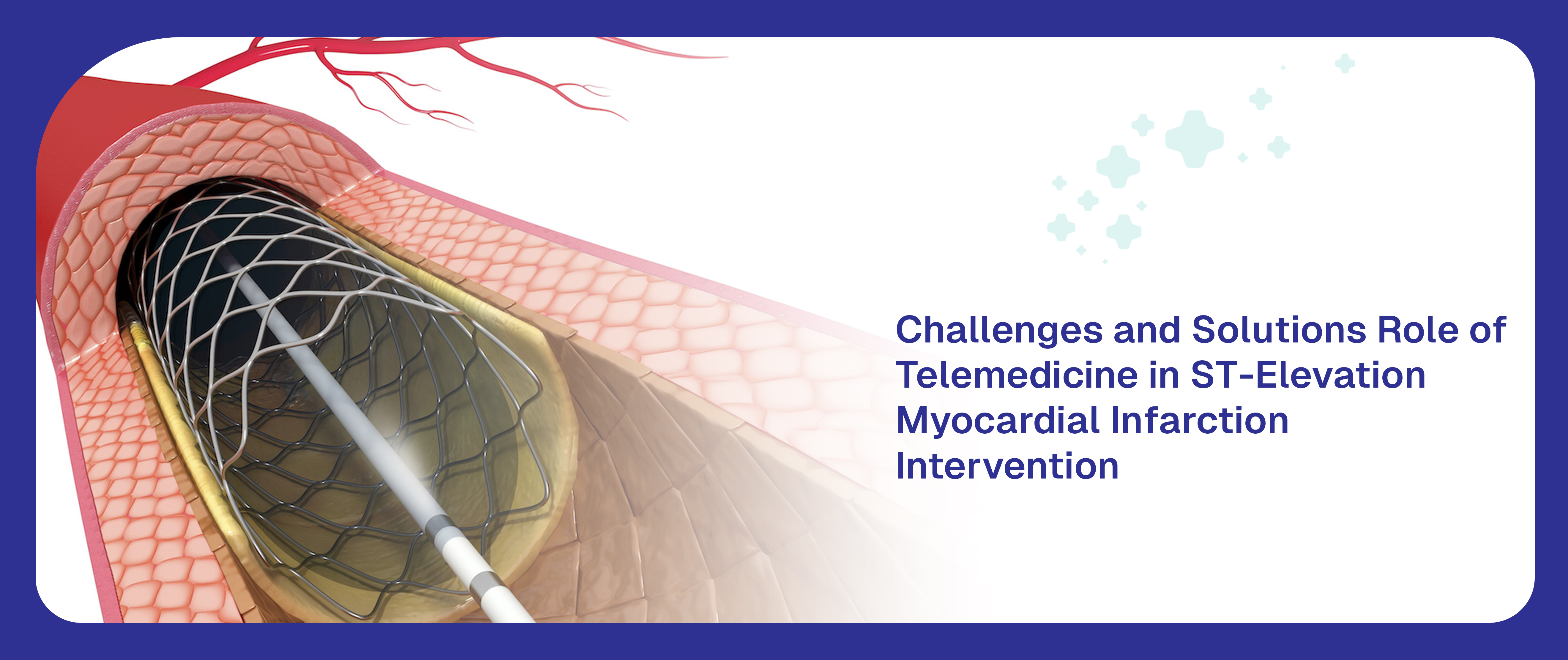 Global Challenges and Solutions Role of Telemedicine in ST-Elevation Myocardial Infarction Intervention